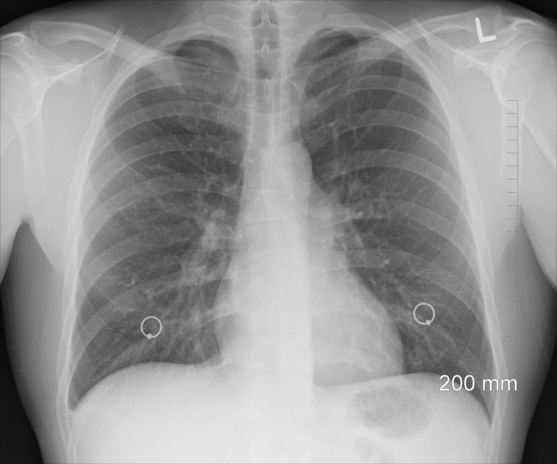 Поражением легких 50. Коронавирусная пневмония на рентгене. Снимки легких. Снимок лёгких. Рентген лёгких.